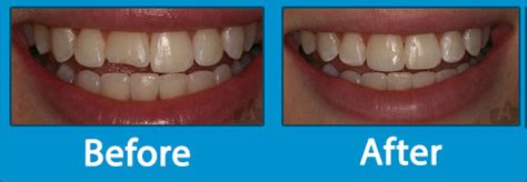 Restorative Dentistry Kelowna | Tooth Restoration