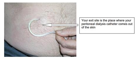 Peritoneal Dialysis Catheter Insertion