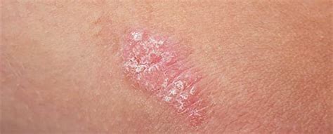 Psoriasis Pityriasis Rosea: Symptoms And Causes, 60% OFF