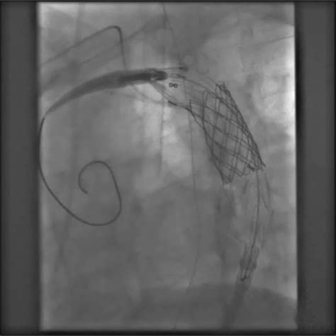 Deployment Of The Medtronic Valiant Thoracic Stent Graft Download