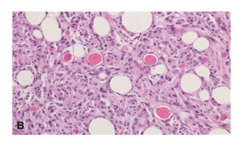 Hematoxylin And Eosin Stain Of The Tumor Tissue A X100 Magnification