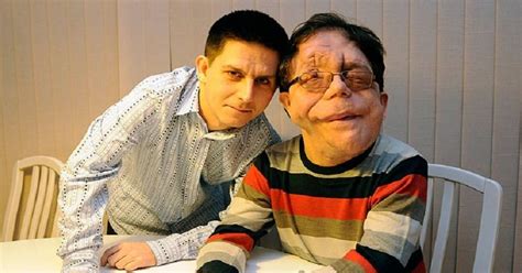 Adam Pearson And His Identical Twin Brother Neil Both Have