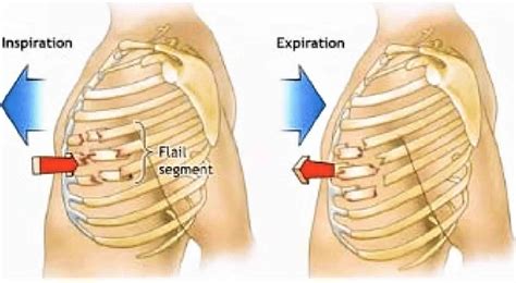 Flail Chest Definition Causes Symptoms Diagnosis Treatment And Prognosis