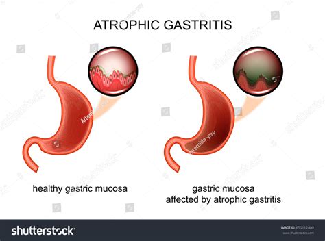 Vector Illustration Atrophic Gastritis Inflammation Mucous เวกเตอร