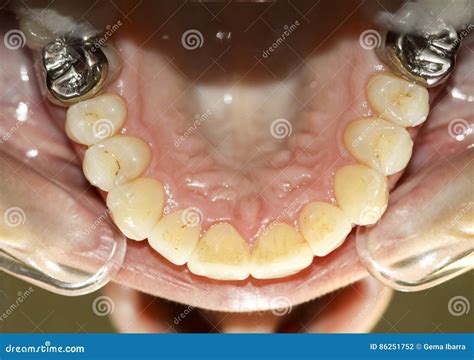 Open Mouth With Dental Opener Stock Photo Image Of Woman Dentistry