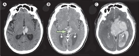 Imaging Of Intracranial Haemorrhage The Lancet Neurology