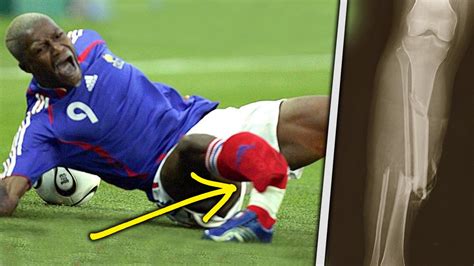 Really Bad Football Injuries