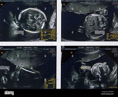 Nd Trimester Ultrasound Of A Fetus Stock Photo Alamy