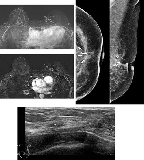 Lumpectomy Plos One