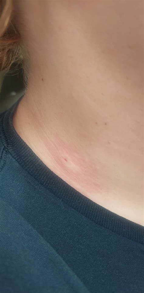 Does anyone know what kind of bug this bite is from? : r/bugbites