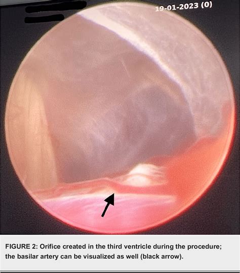 Figure 2 From Endoscopic Third Ventriculostomy In A 12 Year Old With