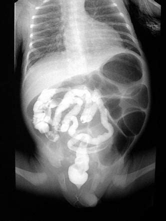 Meconium Ileus Ultrasound