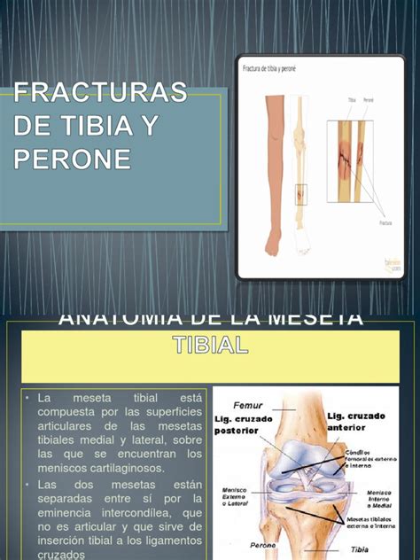 Pdf Expo De Traumatologia Tibia Ppt Phpapp