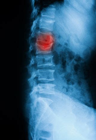 Vertebral Compression Fractures | Murfreesboro Vascular and Interventional