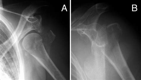 Kocher Maneuver Shoulder