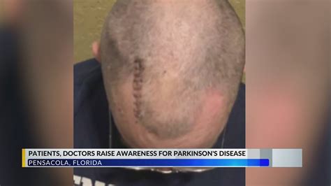 Patients Doctors Advocate For Deep Brain Stimulation Procedure During