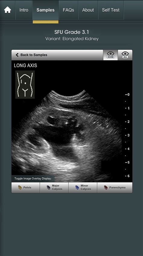 Cevl Training To Sfu Grade Pediatric Hydronephrosis A Guide For Pediatric Caregivers Journal