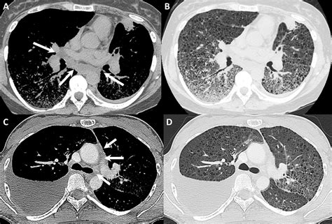 Computed Tomographic Features Of Lymphangioleiomyomatosis Evaluation