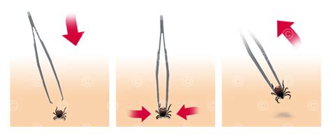 Illustration Entfernung Zecken Medicalgraphics