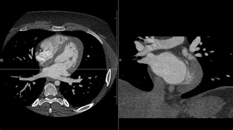 Cardiac Cta Anatomy Youtube