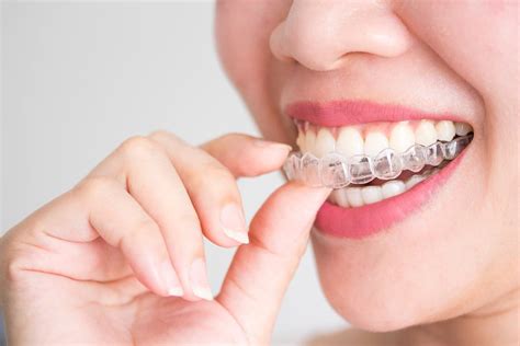 Invisalign Attachments What They Are And How They Work