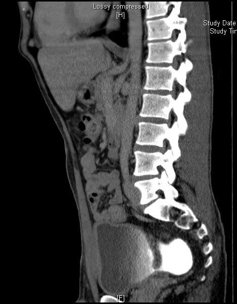 Hutch Diverticulum Urinary Bladder Image