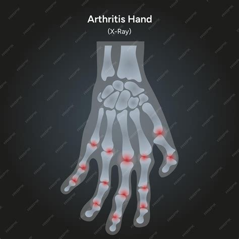 Premium Vector | Rheumatoid arthritis human hand xray