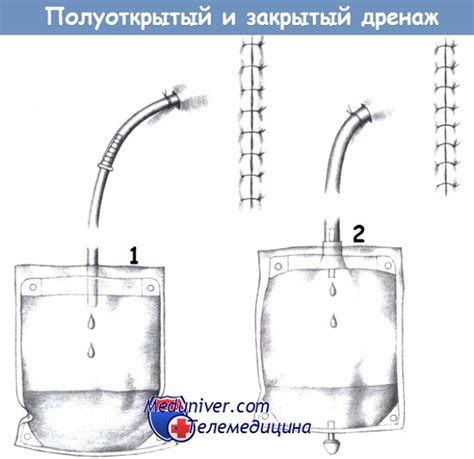 Виды и применение дренажей в хирургии