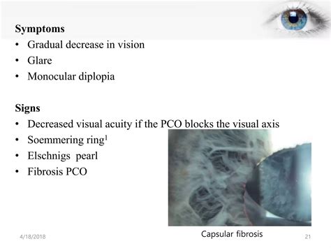 Posterior Capsular Opacification Ppt