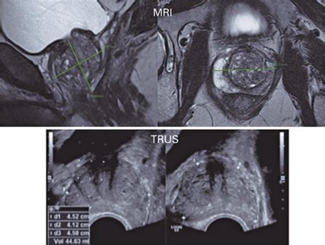 Scielo Brasil Prostate Volume Measurement By Multiparametric