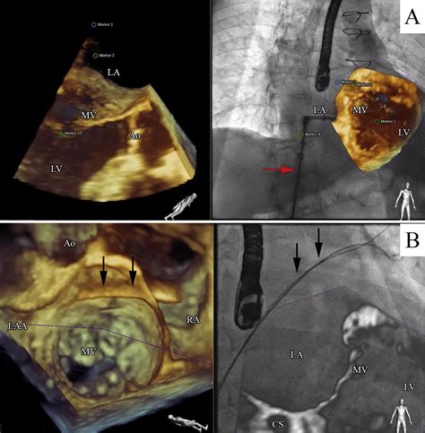 Echocardiographic And Fluoroscopic Fusion Imaging For Procedural