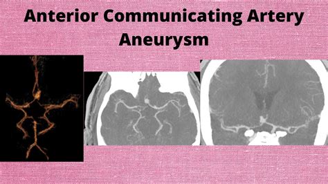 Anterior Communicating Artery Acom Aneurysm Youtube