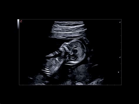 Obstetric Ultrasound Clinical Solutions - Esaote