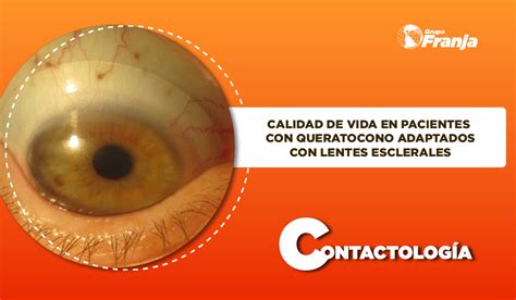 Calidad De Vida En Pacientes Con Queratocono Adaptados Con Lentes