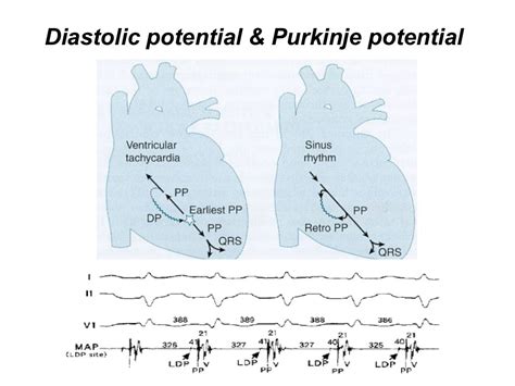 Catheter Ablation Of Ventricular Tachycardia