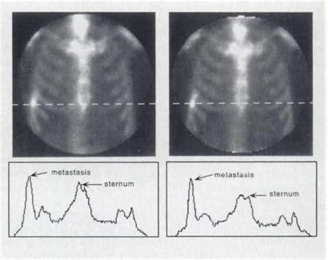 Ratio Of Spatial Resolution In Tangential Fwhm And In Radial