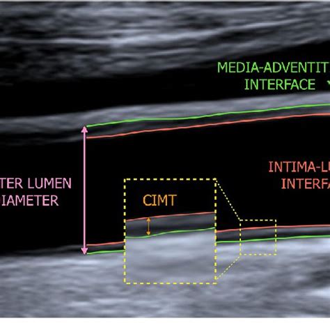 B Mode Ultrasound Image Of The Common Carotid Artery Longitudinal