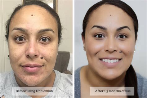 4 Steps To Clear Skin With Rodan Fields Unblemish Makeup Life And Love