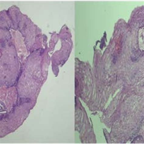 Image Showing Hyperplastic Overlying Stratified Squamous Epithelium