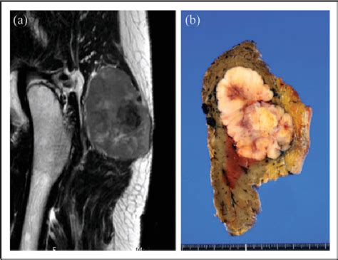 Figure From Extra Articular Diffuse Type Tenosynovial Giant Cell