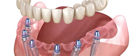 Materials Used in Dentures: A Comprehensive Guide