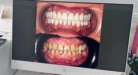 Стоматология ВИНИР