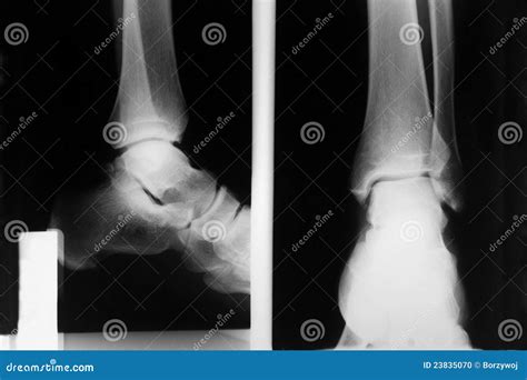 Foot Xray Showing Soft Tissue Gas In Patient With Necrotizing