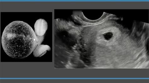 First Trimester Ultrasound - Radiology Course - MRI Online is now Medality