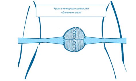 Фото пупочной грыжи у взрослого человека