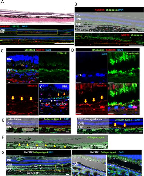 Graft Cell Expansion From HiPSC RPE Strip After Transplantation In