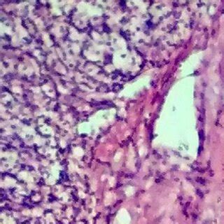 Gross appearance of clear cell sarcoma of left kidney.5 cm diameter... | Download Scientific Diagram