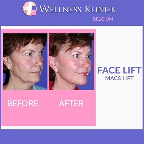 Wellness Kliniek Belgium Facelift MACS Lift Cosmetic Faci Flickr