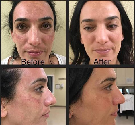 Microneedling Before And After Jj Ellie Skincare