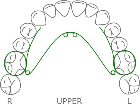 Quad Helix Expander - Orthodontic Resource Group